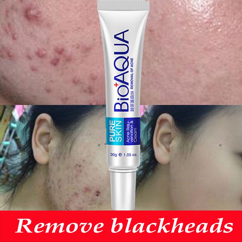 Bioaqua 30g Acne Treatment Blackhead Remova Anti Acne Cream