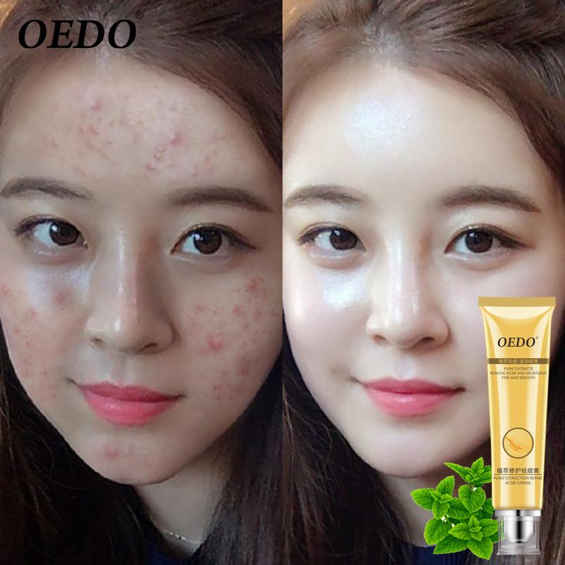 Herbal plant extract repair cream remove acne marks